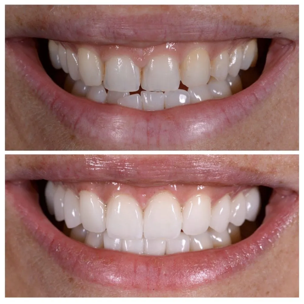 Carolina's smile before (top) and after (bottom) treatment with Dr. Andi-Jean Miro