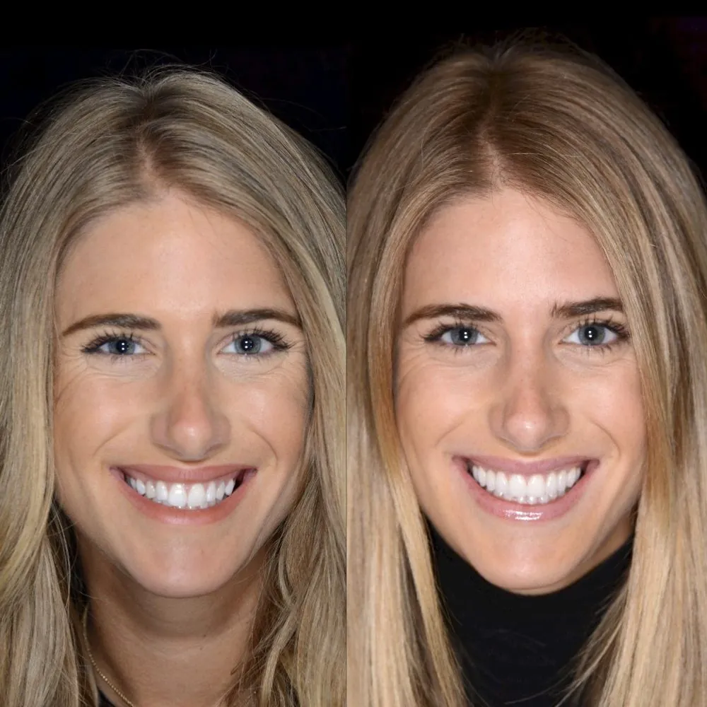 Porcelain veneer smile makeover before and after by Dr. Andi-Jean Miro, cosmetic dentist