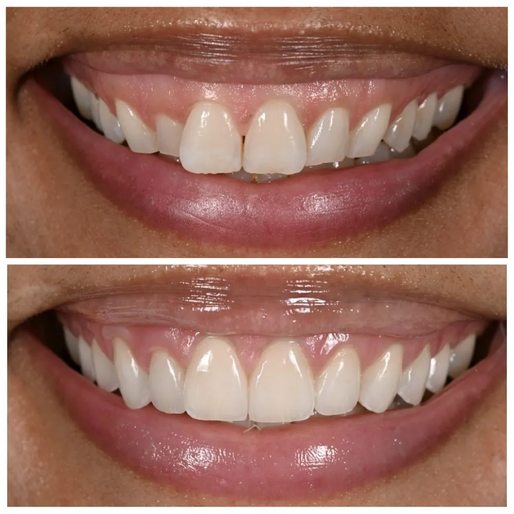 Cosmetic dentistry by Dr. Andi-Jean Miro at Apa Aesthetic, Beverly Hills and New York