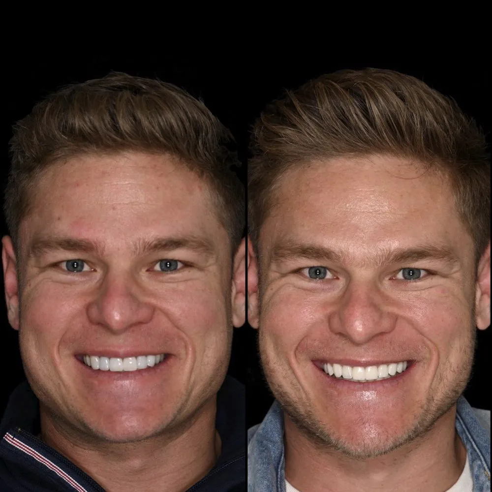 Porcelain veneer smile makeover before and after by Dr. Andi-Jean Miro, cosmetic dentist
