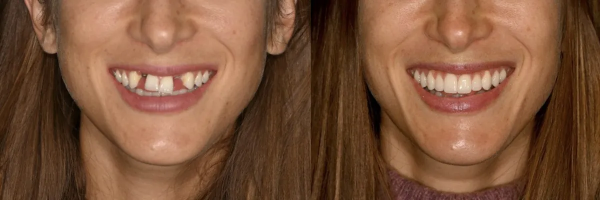 Full-face before and after of the finished smile — actual patient of Dr. Andi-Jean Miro
