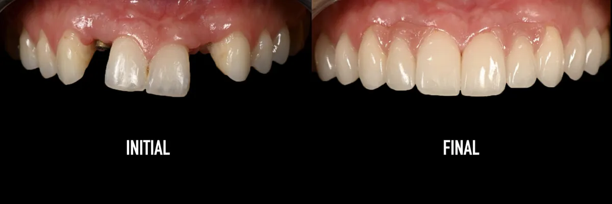 Initial retracted view with missing teeth vs the final restoration — actual patient of Dr. Andi-Jean Miro