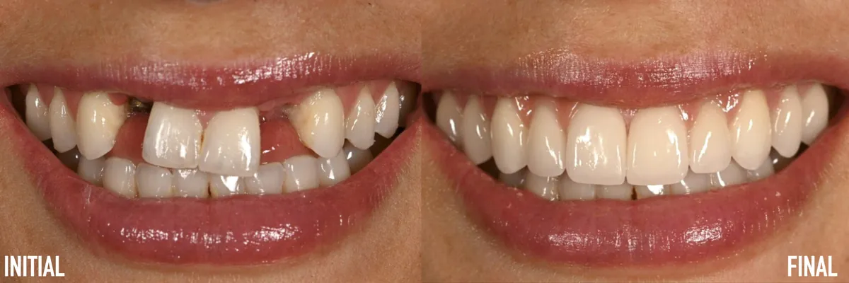 Initial smile vs the conservative final rebuild — actual patient of Dr. Andi-Jean Miro
