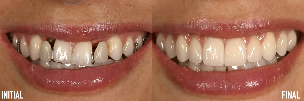 Initial presentation after years of orthodontics vs the final smile — actual patient of Dr. Andi-Jean Miro