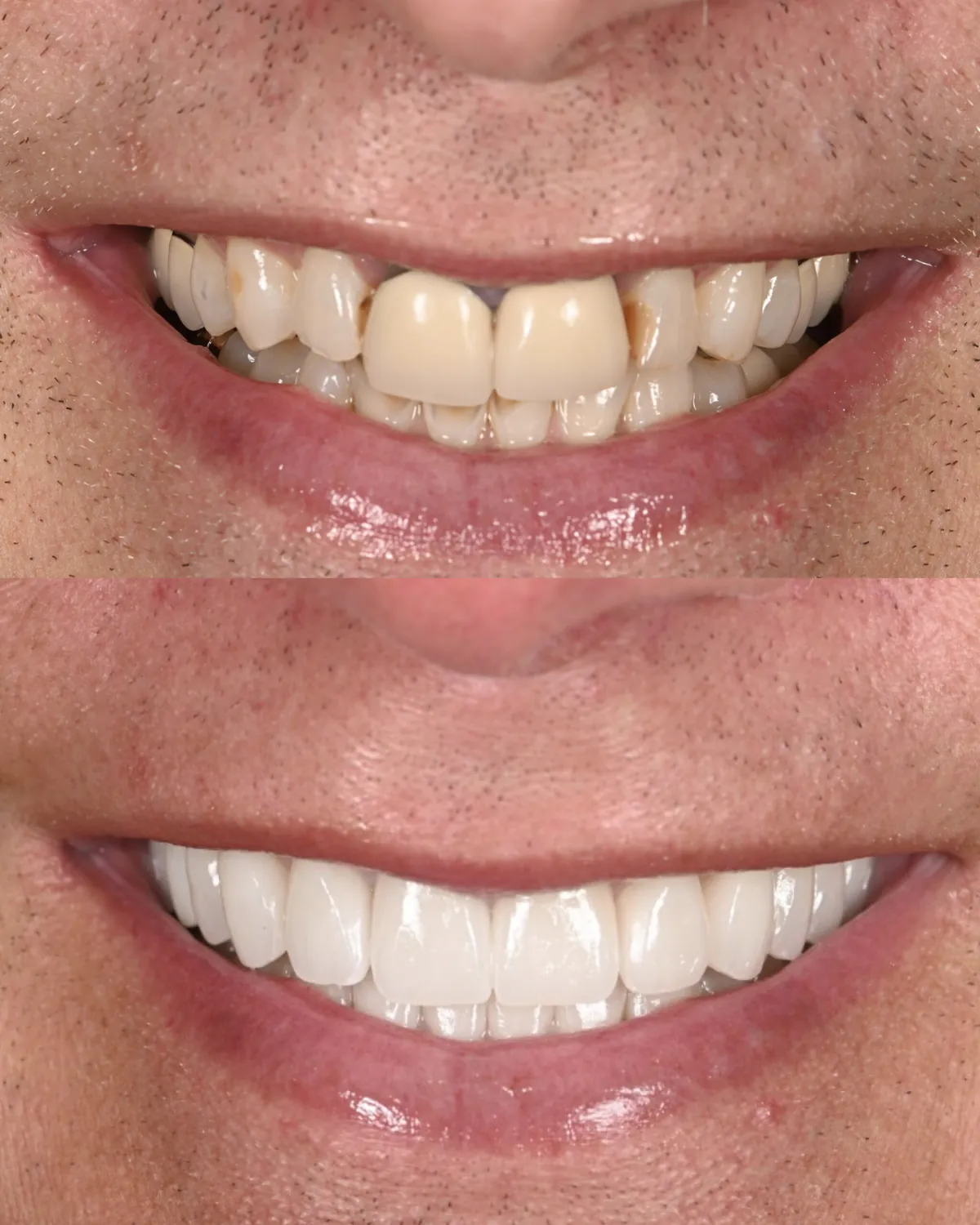 Before and after: worn, discolored front teeth and old crowns restored with porcelain — actual patient of Dr. Andi-Jean Miro