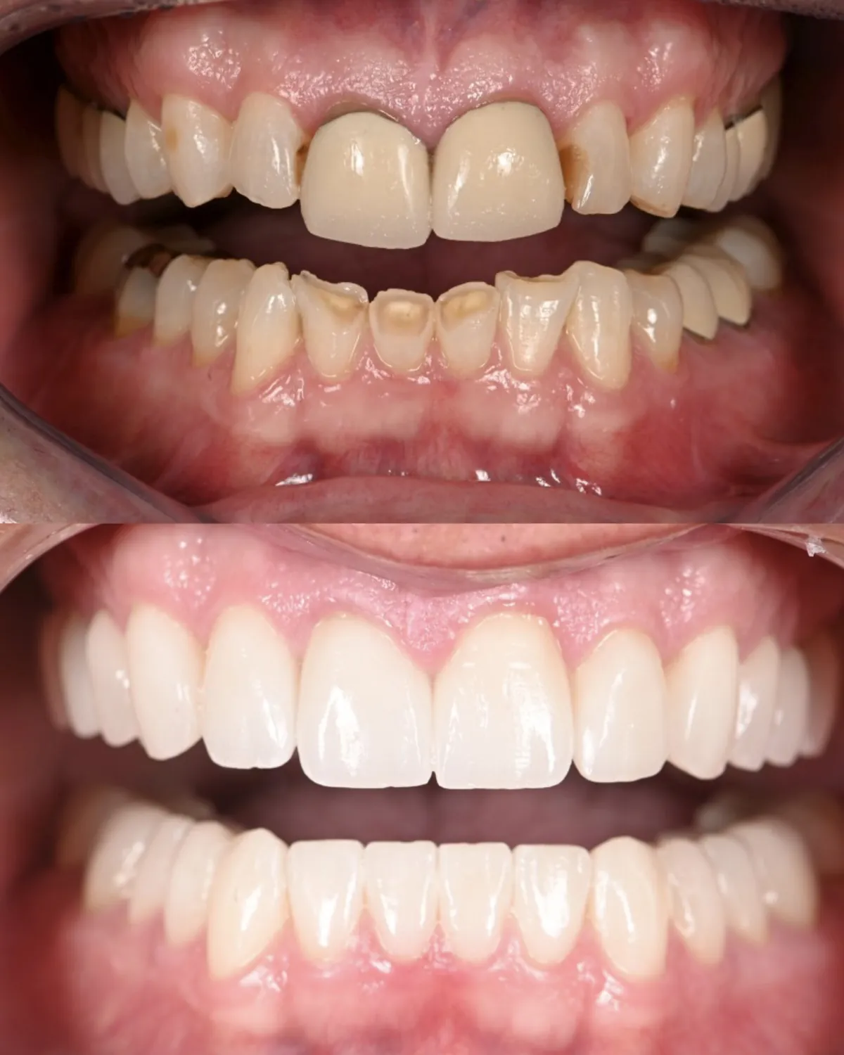 Retracted view before and after a full upper and lower restoration of worn teeth — actual patient of Dr. Andi-Jean Miro