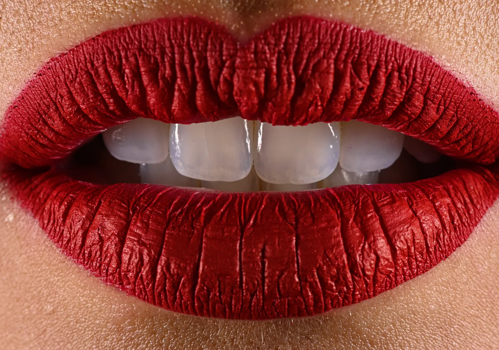 Veneers