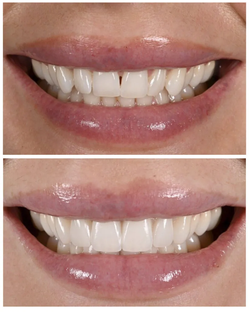 Before and after porcelain veneers in Beverly Hills by Dr. Andi-Jean Miro, closing gaps and evening the front teeth