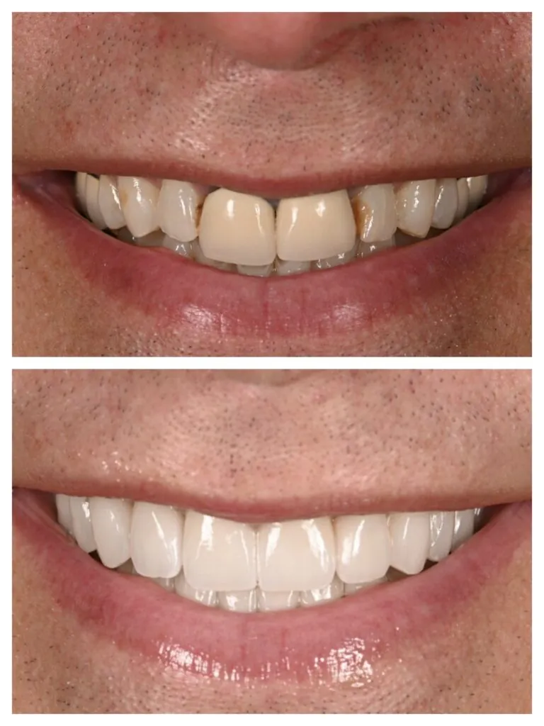 Smile wear restored by Dr. Andi Miro 