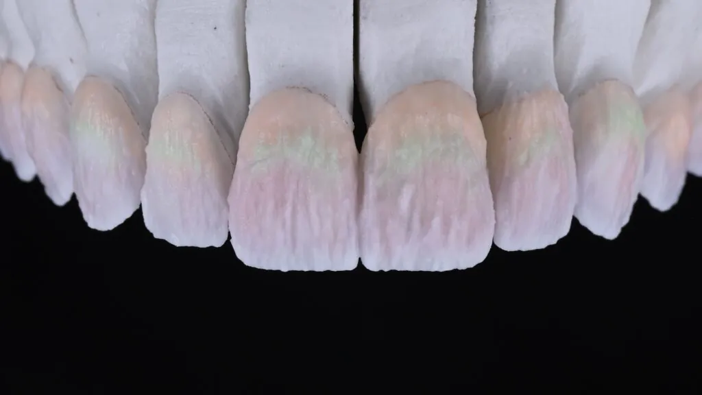 Handlayering Porcelain Veneers