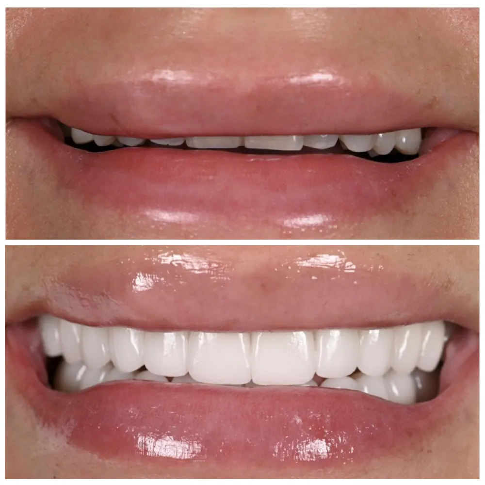 Porcelain veneers to enhance a smile 