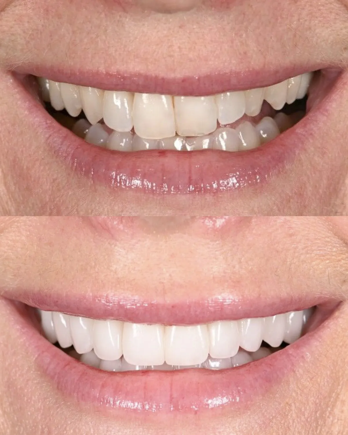 Close-up smile before and after a smile lift rebuilding worn tooth length — actual patient of Dr. Andi-Jean Miro