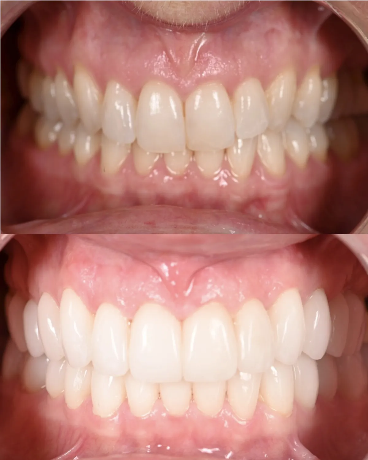 Retracted view before and after a smile lift restoring tooth height in both arches — actual patient of Dr. Andi-Jean Miro