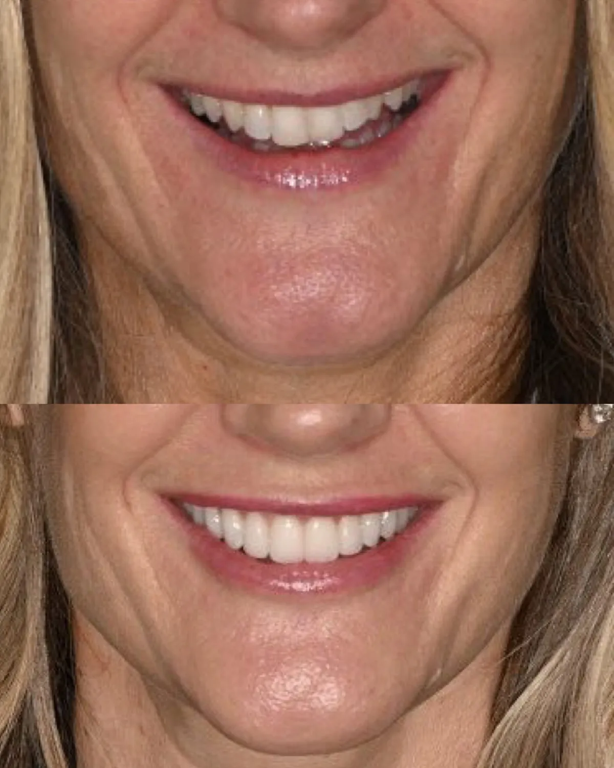 Lower face before and after a smile lift, showing restored lip and chin support — actual patient of Dr. Andi-Jean Miro