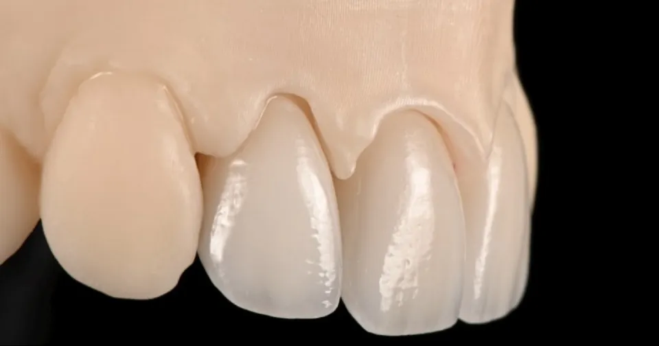 Close-up of porcelain veneers showing natural translucency — veneers vs. dental bonding