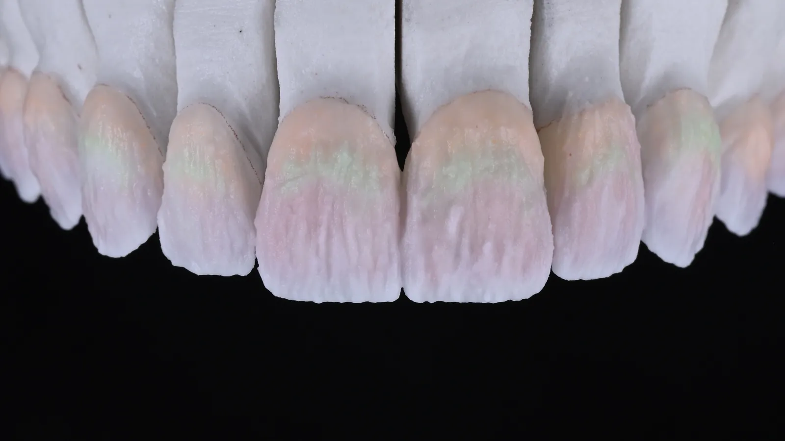 Smile makeover story