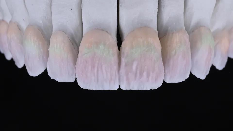 Smile makeover story