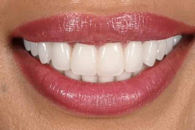 Close-up of a natural-looking porcelain veneer smile designed by Dr. Andi-Jean Miro in Beverly Hills