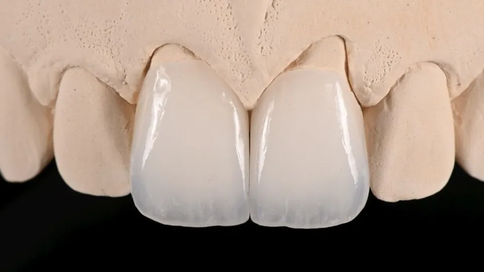 Two hand-layered porcelain veneers on a stone dental model, from Dr. Andi-Jean Miro's Journal on who makes your veneers