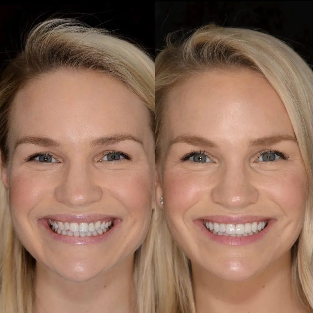Lizzy, before and after porcelain veneers with Dr. Andi-Jean Miro