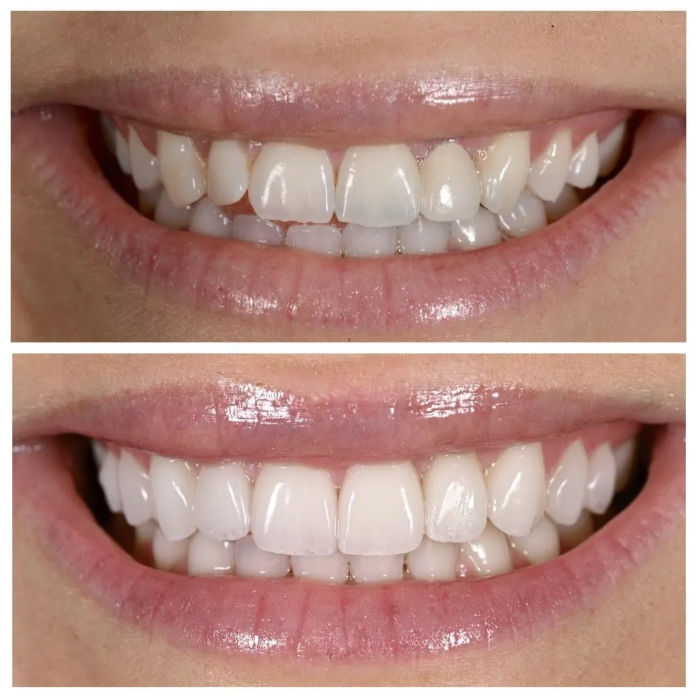 Lizzy's smile before (top) and after (bottom) treatment with Dr. Andi-Jean Miro