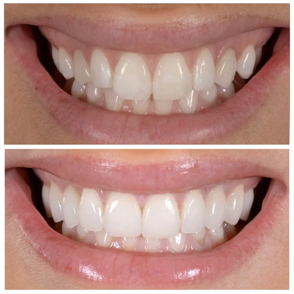 Marissa's smile before (top) and after (bottom) treatment with Dr. Andi-Jean Miro