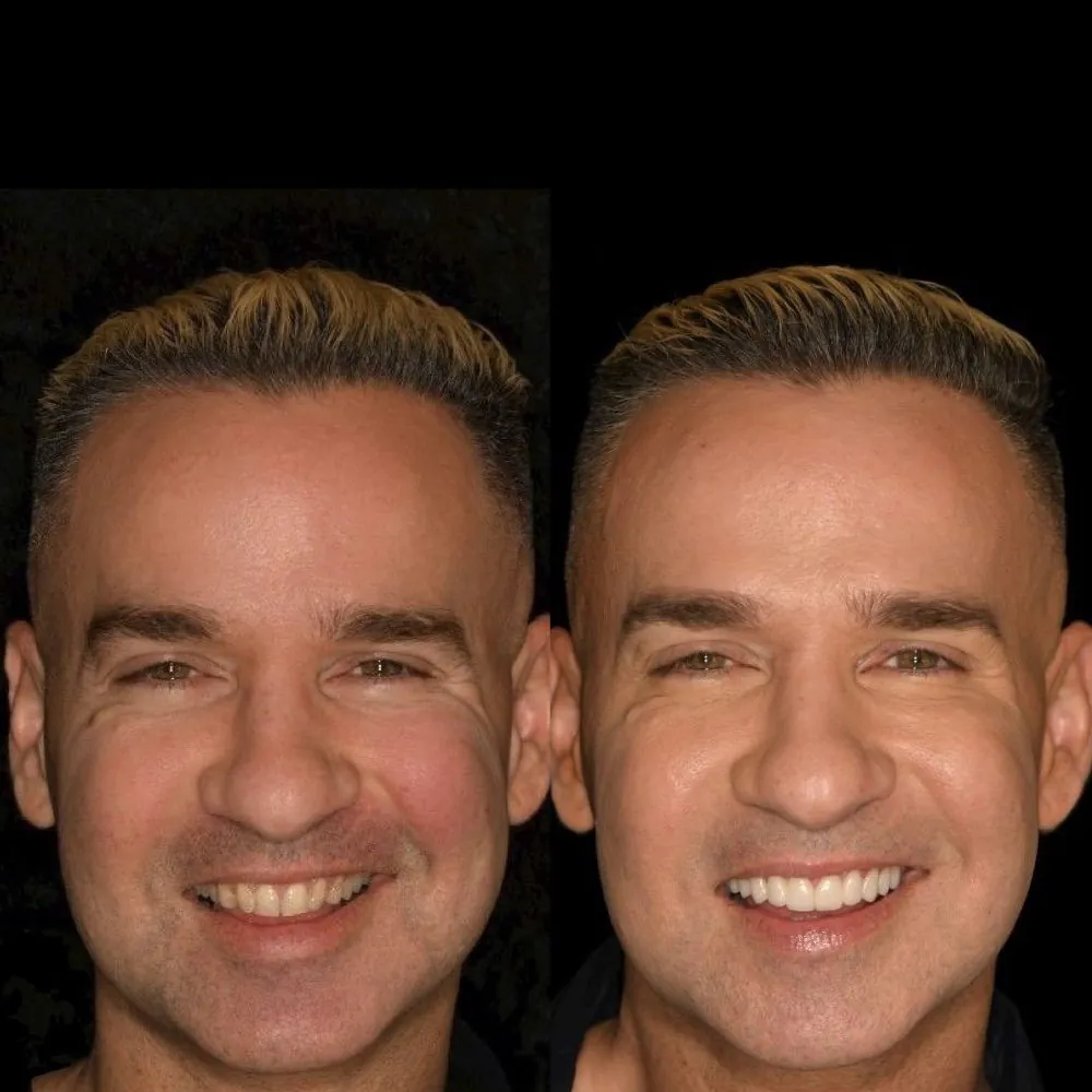 Mike, before and after porcelain veneers with Dr. Andi-Jean Miro