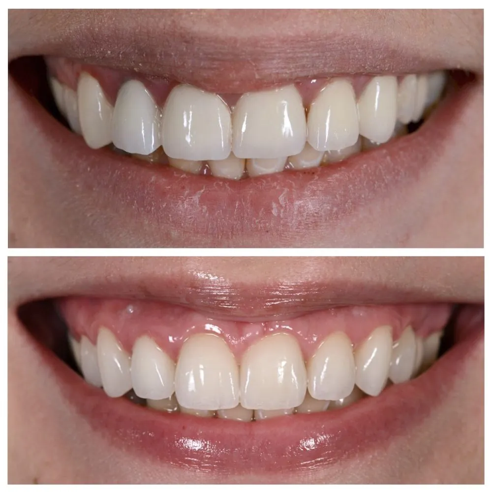 Porcelain veneers before (top) and after (bottom), case 1, Dr. Andi-Jean Miro at Apa Aesthetic