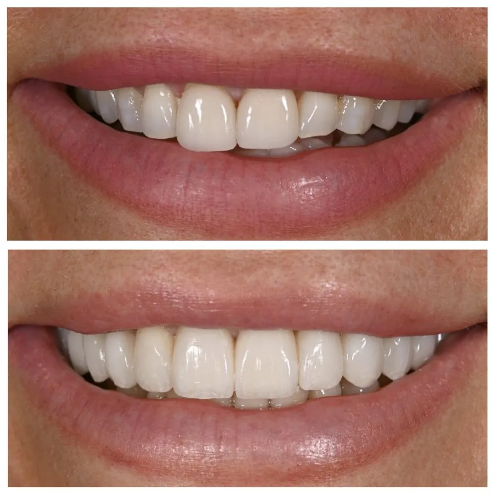 Porcelain veneers before (top) and after (bottom), case 2, Dr. Andi-Jean Miro at Apa Aesthetic