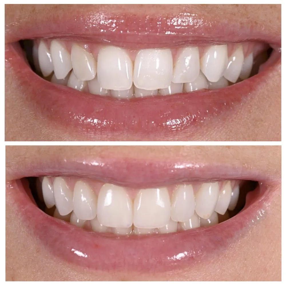 Porcelain veneers before (top) and after (bottom), case 3, Dr. Andi-Jean Miro at Apa Aesthetic