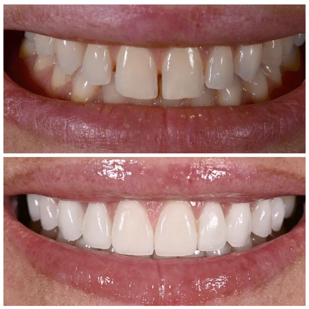 Porcelain veneers before (top) and after (bottom), case 4, Dr. Andi-Jean Miro at Apa Aesthetic