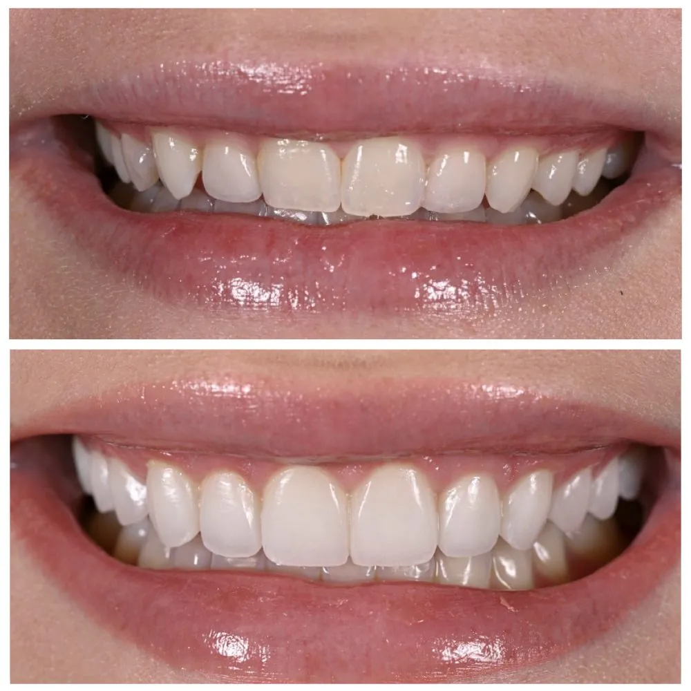 Porcelain veneers before (top) and after (bottom), case 5, Dr. Andi-Jean Miro at Apa Aesthetic