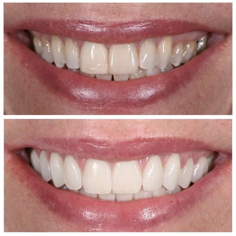 Porcelain veneers before (top) and after (bottom), case 6, Dr. Andi-Jean Miro at Apa Aesthetic