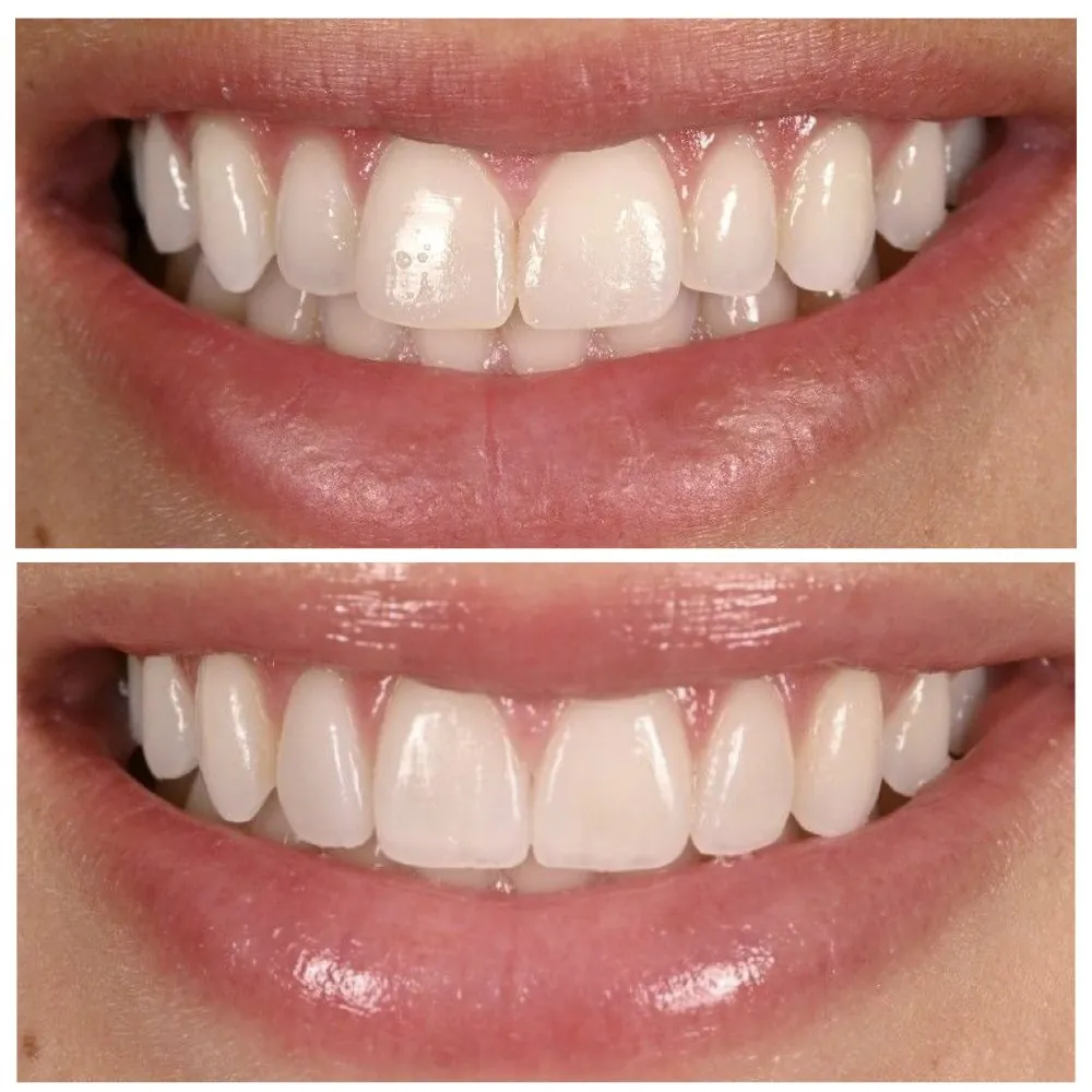 Porcelain veneers before (top) and after (bottom), case 7, Dr. Andi-Jean Miro at Apa Aesthetic