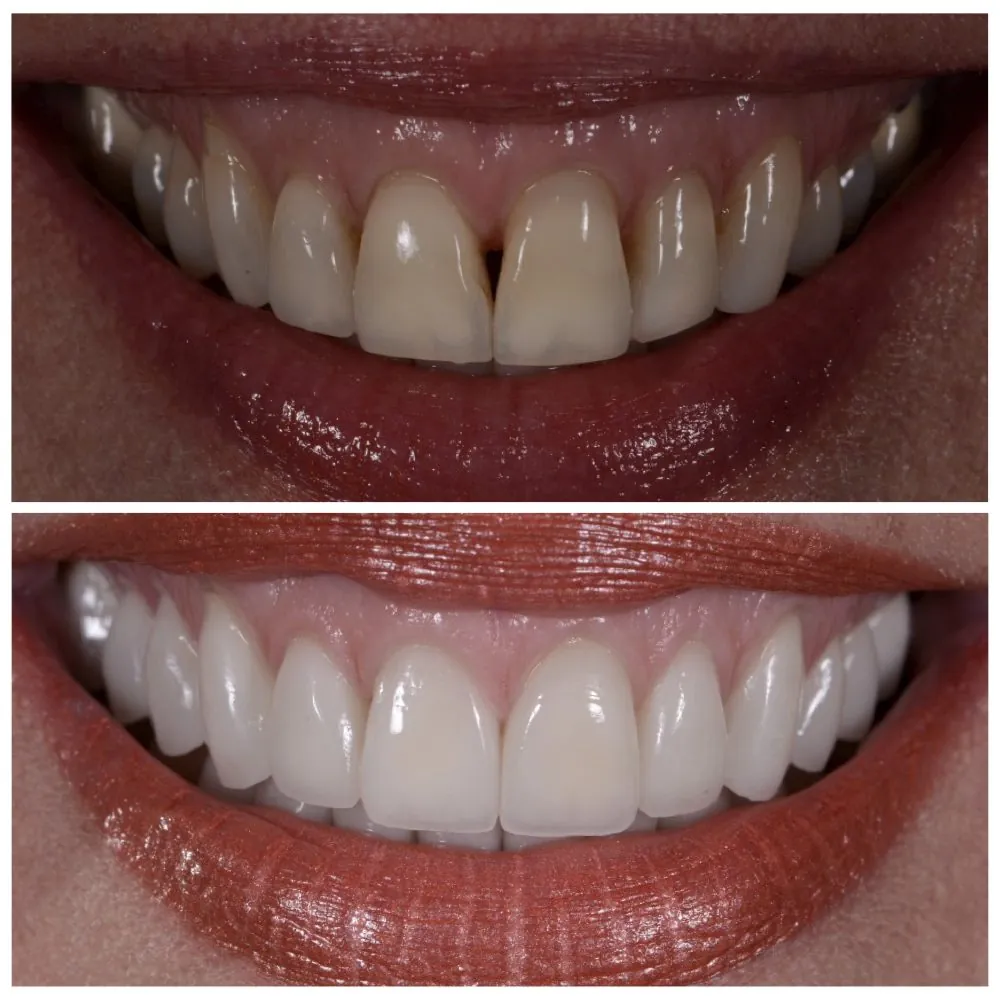 Porcelain veneers before (top) and after (bottom), case 8, Dr. Andi-Jean Miro at Apa Aesthetic