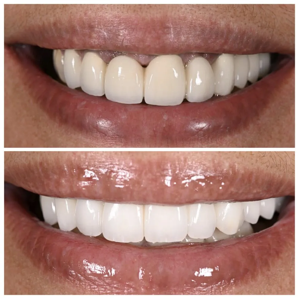 Porcelain veneers before (top) and after (bottom), case 9, Dr. Andi-Jean Miro at Apa Aesthetic
