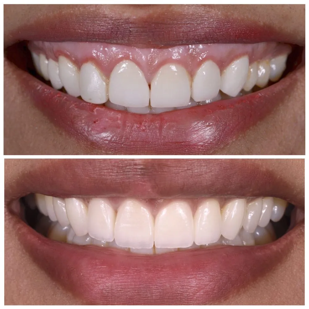 Porcelain veneers before (top) and after (bottom), case 10, Dr. Andi-Jean Miro at Apa Aesthetic
