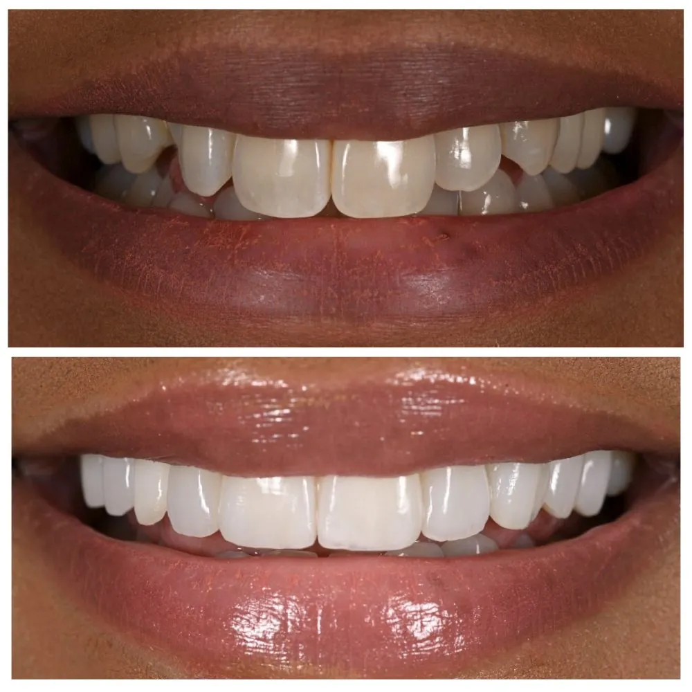 Porcelain veneers before (top) and after (bottom), case 11, Dr. Andi-Jean Miro at Apa Aesthetic