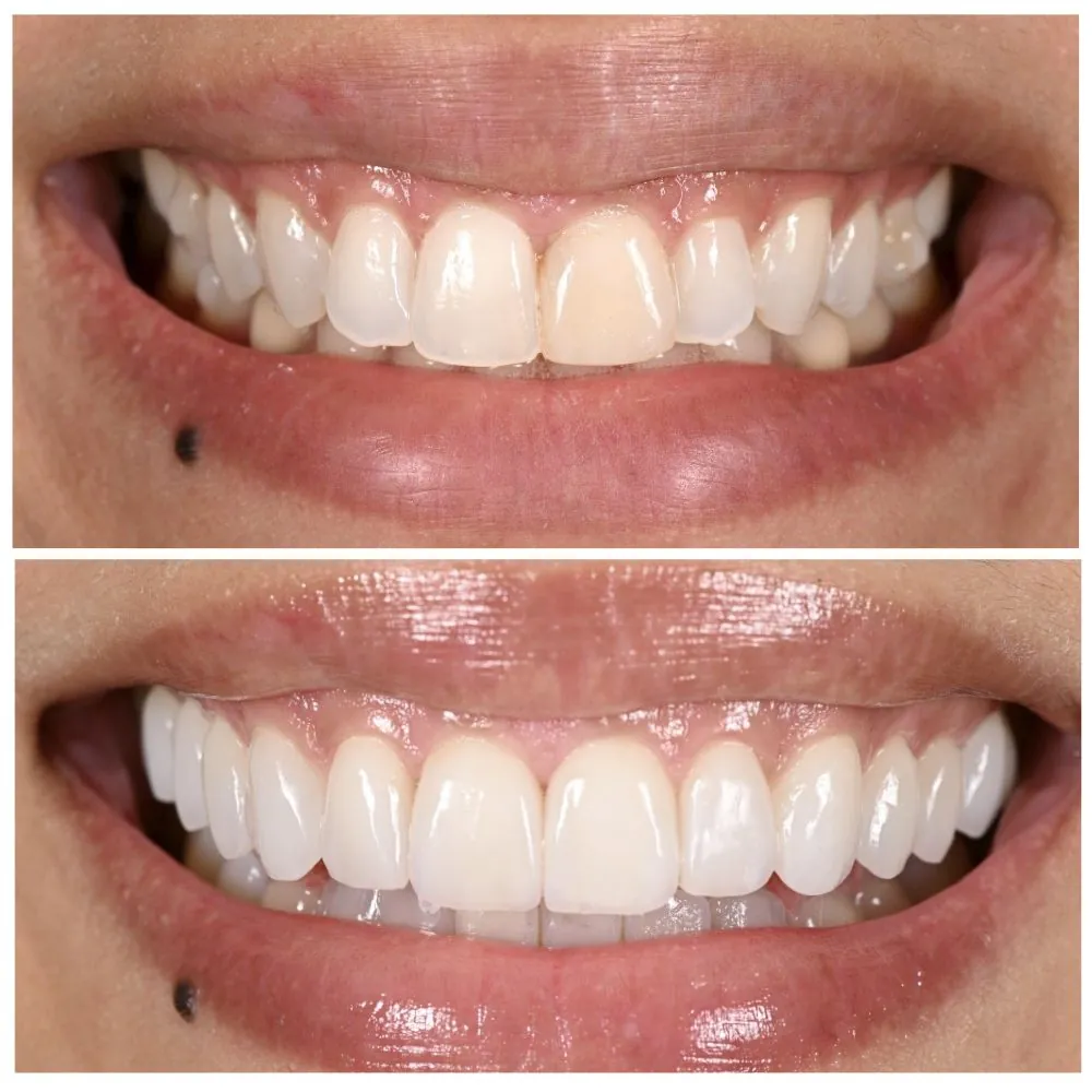 Porcelain veneers before (top) and after (bottom), case 12, Dr. Andi-Jean Miro at Apa Aesthetic