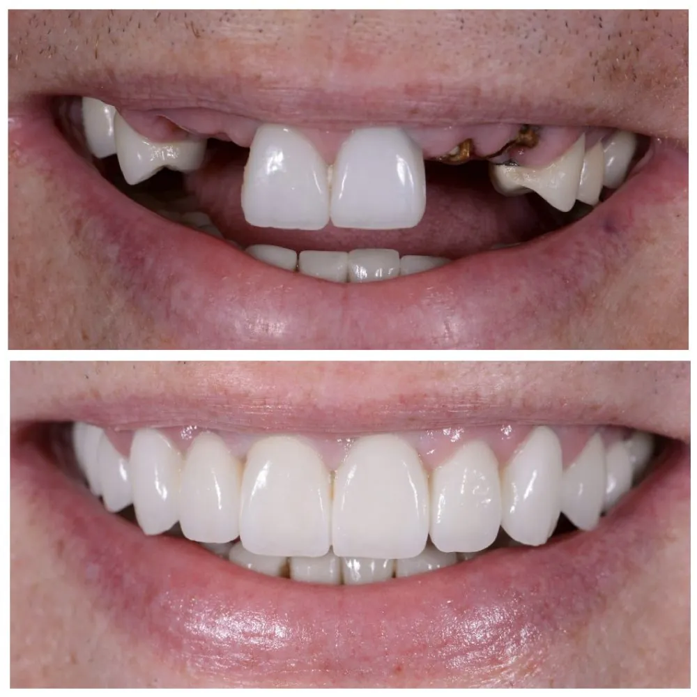 Porcelain veneers before (top) and after (bottom), case 15, Dr. Andi-Jean Miro at Apa Aesthetic