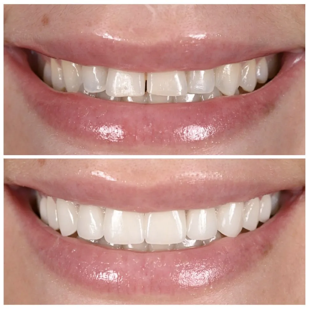Porcelain veneers before (top) and after (bottom), case 16, Dr. Andi-Jean Miro at Apa Aesthetic
