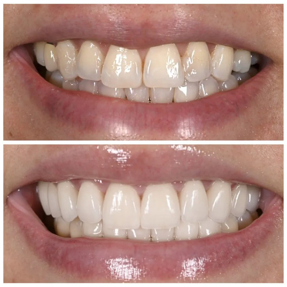 Porcelain veneers before (top) and after (bottom), case 17, Dr. Andi-Jean Miro at Apa Aesthetic