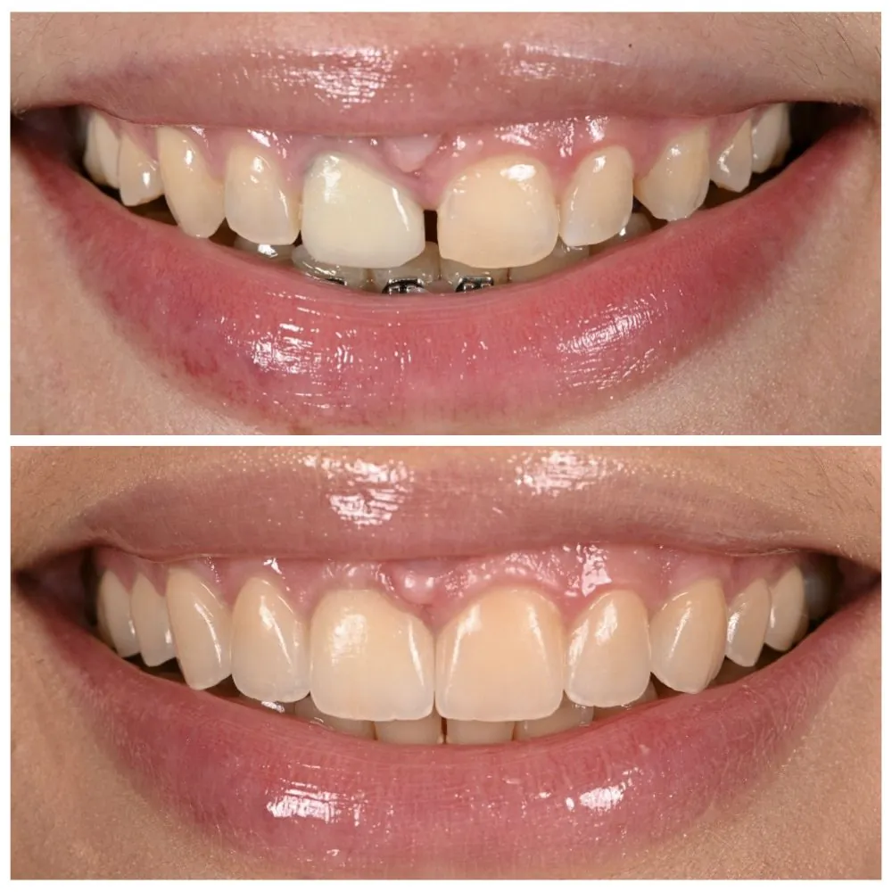 Porcelain veneers before (top) and after (bottom), case 18, Dr. Andi-Jean Miro at Apa Aesthetic