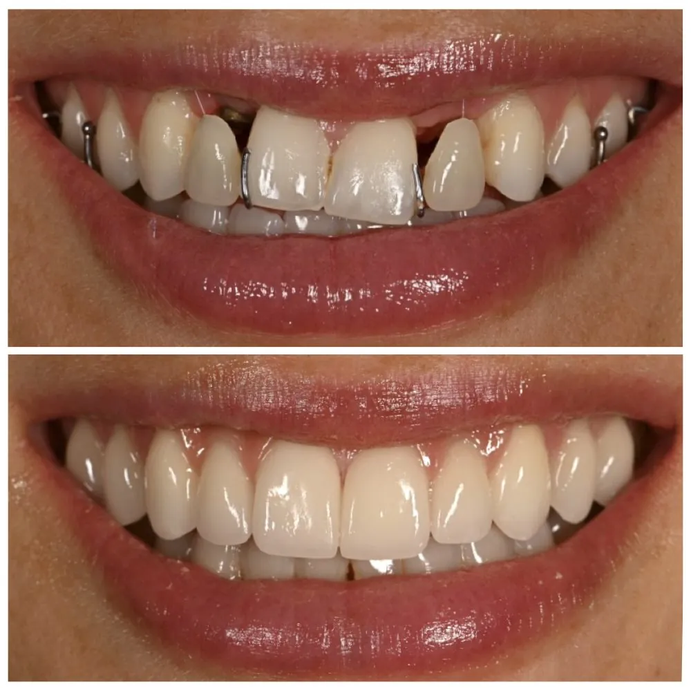 Porcelain veneers before (top) and after (bottom), case 19, Dr. Andi-Jean Miro at Apa Aesthetic