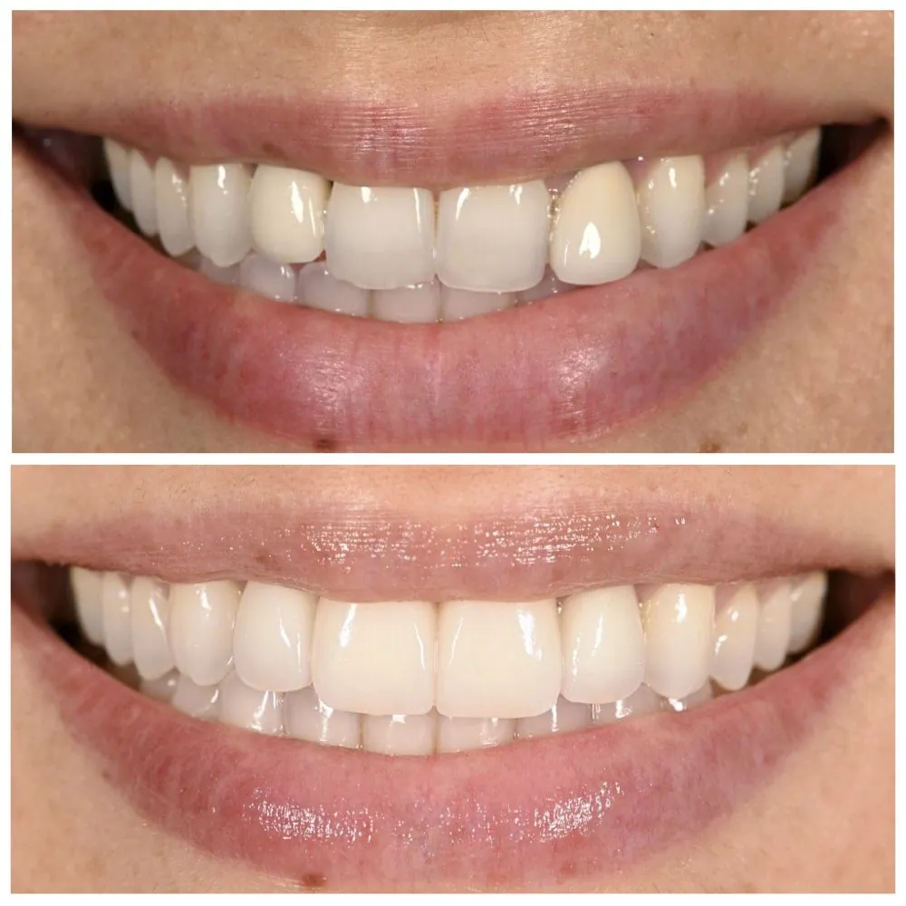 Porcelain veneers before (top) and after (bottom), case 20, Dr. Andi-Jean Miro at Apa Aesthetic
