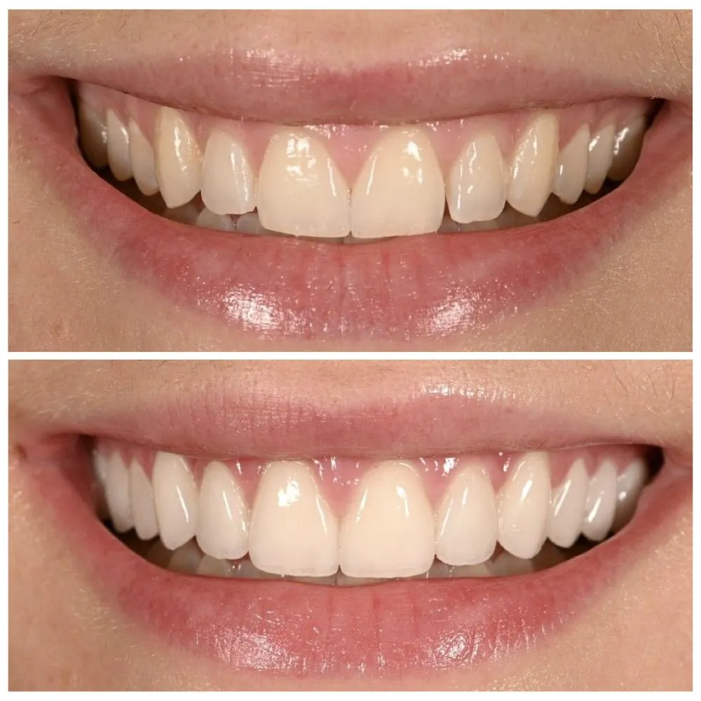 Porcelain veneers before (top) and after (bottom), case 21, Dr. Andi-Jean Miro at Apa Aesthetic