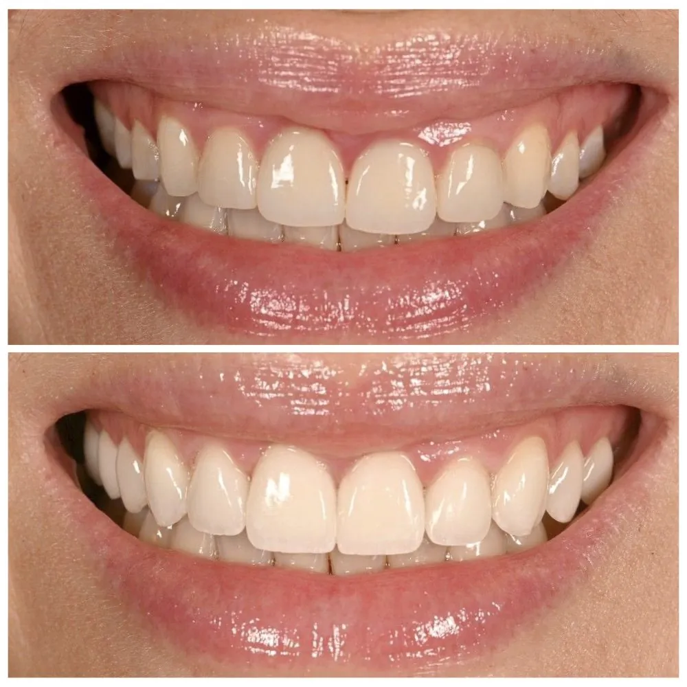 Porcelain veneers before (top) and after (bottom), case 22, Dr. Andi-Jean Miro at Apa Aesthetic