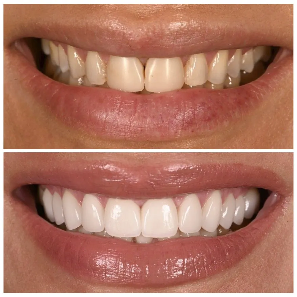 Porcelain veneers before (top) and after (bottom), case 23, Dr. Andi-Jean Miro at Apa Aesthetic