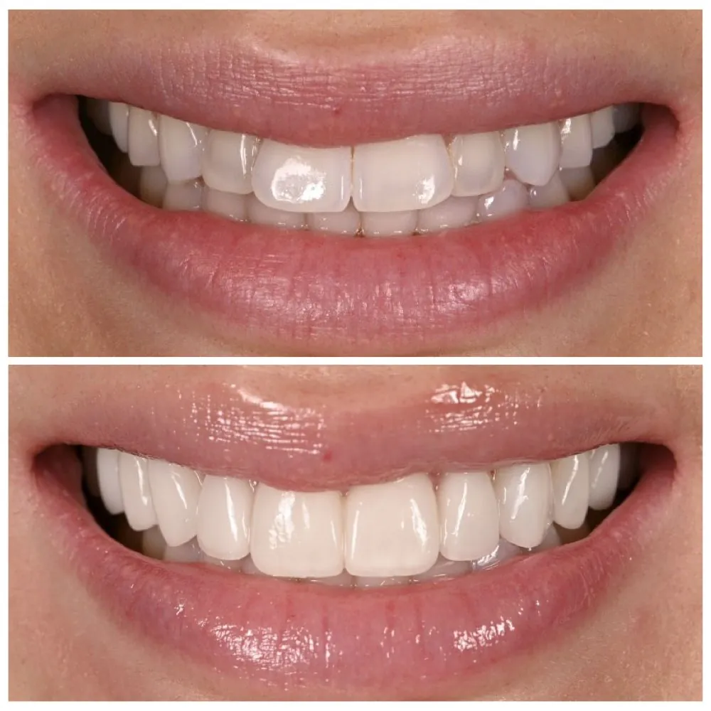 Porcelain veneers before (top) and after (bottom), case 24, Dr. Andi-Jean Miro at Apa Aesthetic