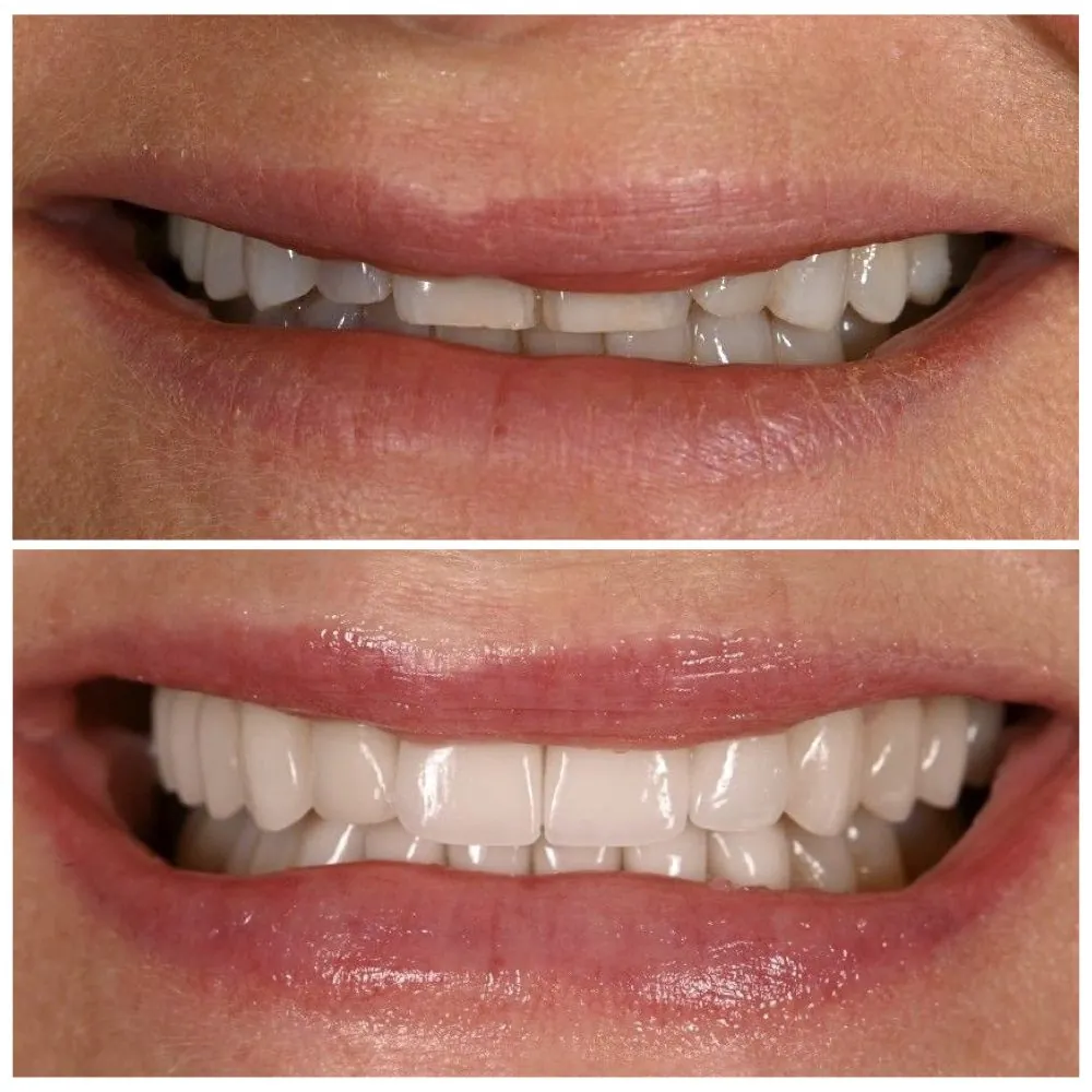 Porcelain veneers before (top) and after (bottom), case 25, Dr. Andi-Jean Miro at Apa Aesthetic